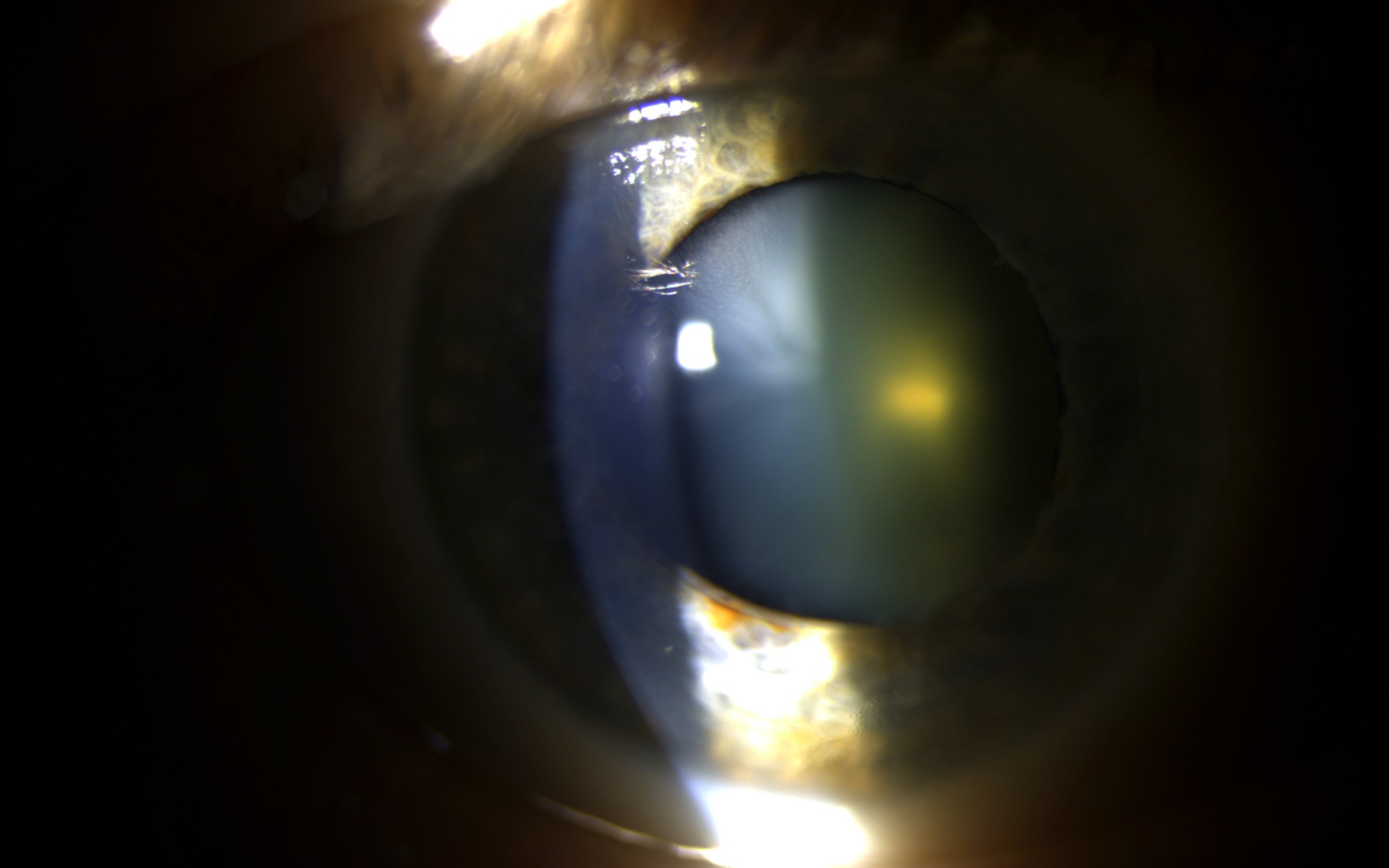 Slit lamp examination showing cloudy lens