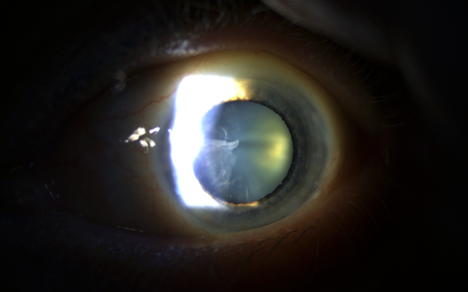 Slit lamp examination showing cataract