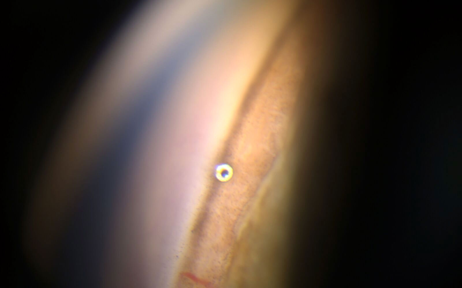 A microscopic trans-trabecular drainage stent used in glaucoma management